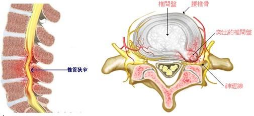 椎间孔狭窄的原因分析和家庭按摩