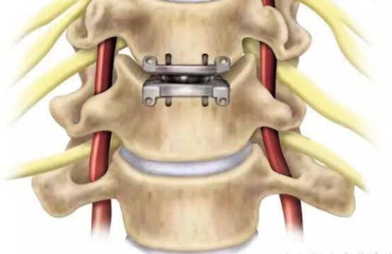 人工颈椎间盘置换术
