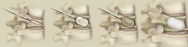 经皮椎体球囊扩张后凸成形术(PKP)